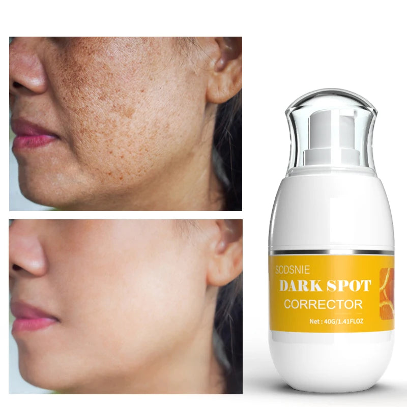 Dark Spot Remover Vitamin C Whitening Remove Melasma Freckle Sun Spots Anti-Pigmentation Improve Dullness Brighten Skin Care