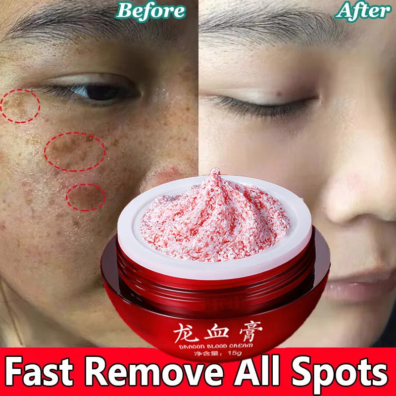 Dragon's Blood Face Cream Effective Whitening Freckles Remove Melasma Dark Spots Lighten Melanin Pigmentation Skin Care Cosmetic