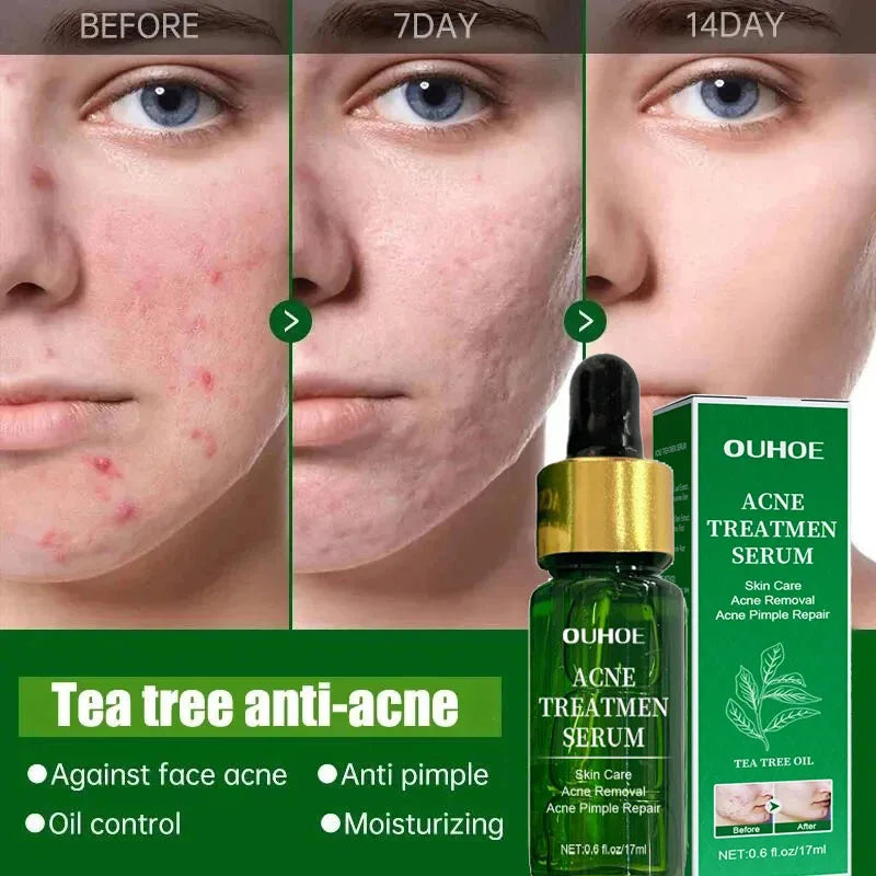 Acne Treatment Facial Serum Pore Shrinking Skin Care Against Face Acne Pimple Spots Remover Cleaning Shrink pores Tea Tree Serum